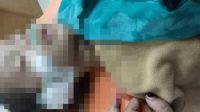 Korban Jalan Berlubang di Dukuhseti, Butuh Donasi Operasi